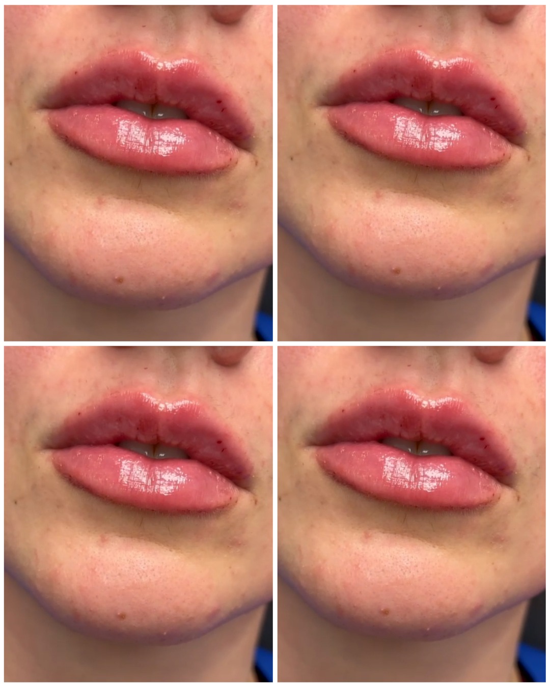 A little enhancement goes a long way! 💕 Soft, natural-looking results for a more defined and re