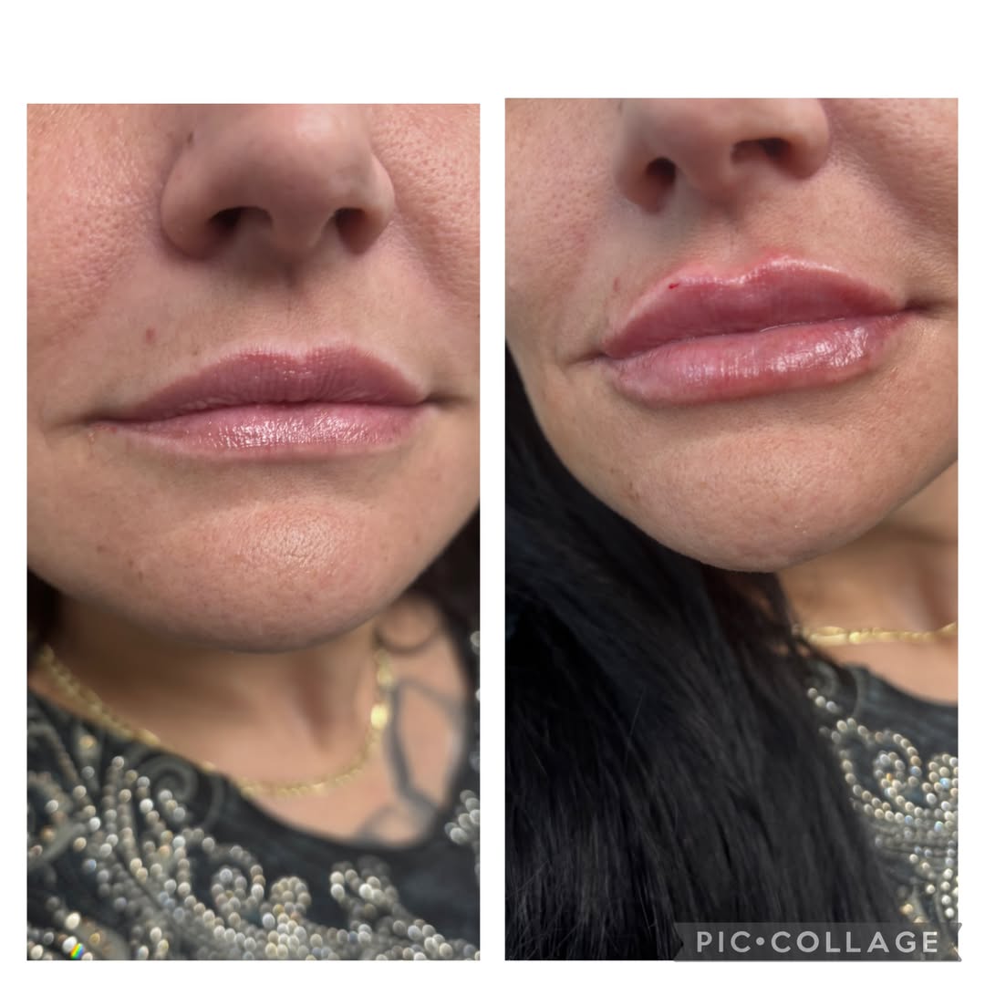 Before & after magic—all in one frame! Check out this stunning lip transformation—fuller, smooth