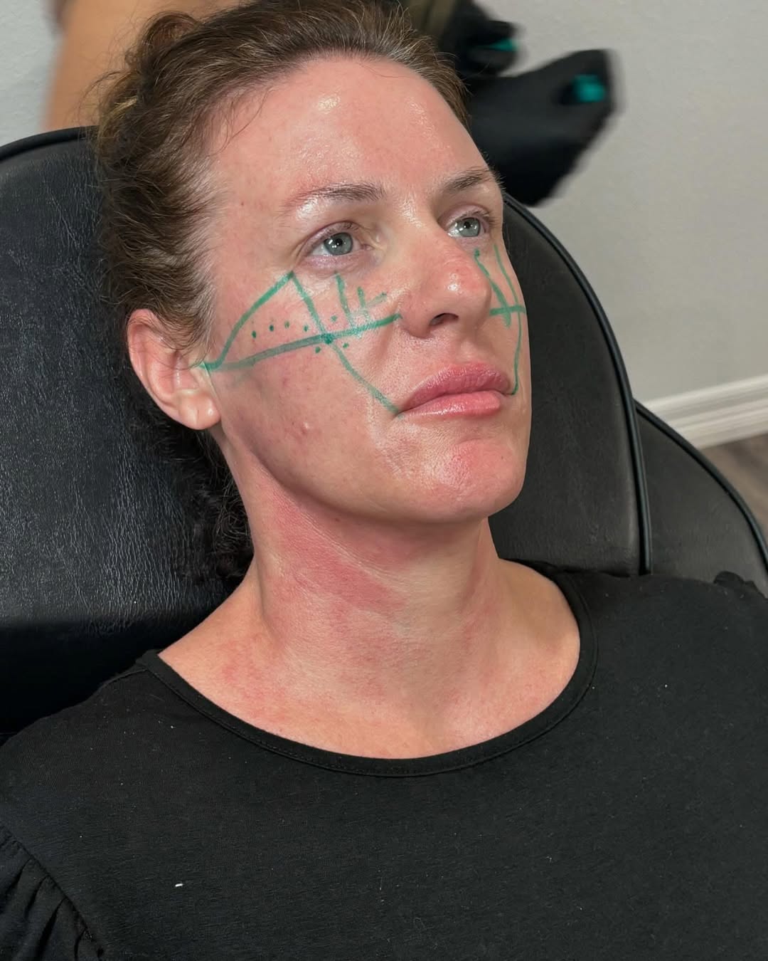 Cheek filler mapping in progress! ✨ This technique helps enhance cheekbone definition and restor
