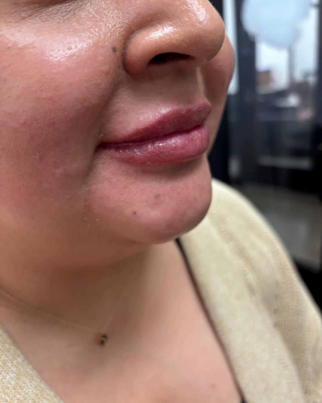 Plump, hydrated, and perfectly defined! Swipe to see this stunning lip transformation. 💋✨#Plump