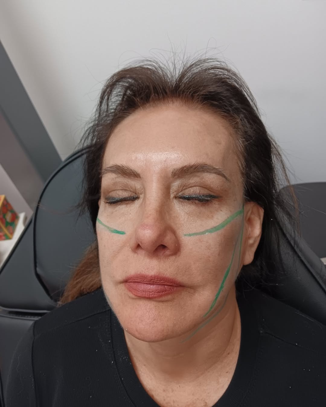 ✨Instant lift. Natural results.✨PDO Threads tighten, lift, and smooth.📆Book your appointment📲8
